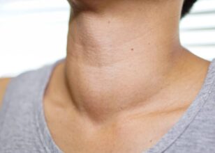 Nadczynność tarczycy