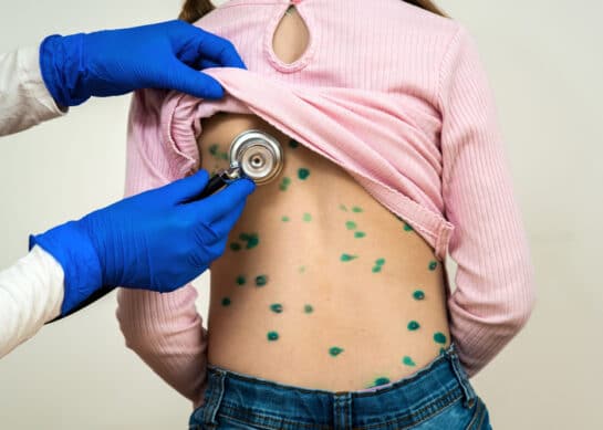 Odra – ryzyko zakażenia, objawy, powikłania, szczepienie, leczenie