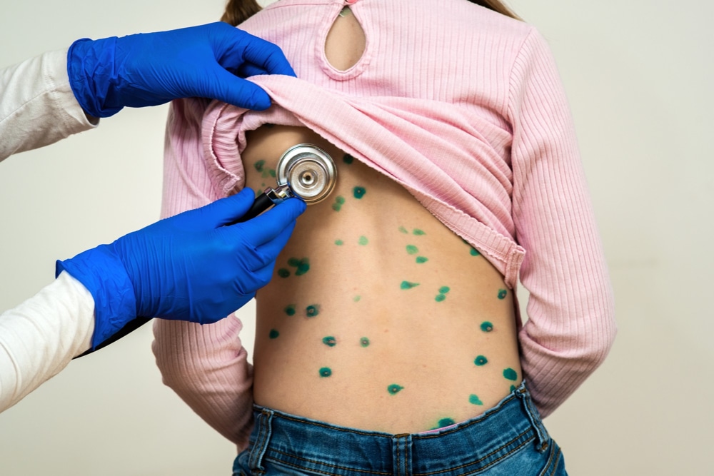 Odra – ryzyko zakażenia, objawy, powikłania, szczepienie, leczenie