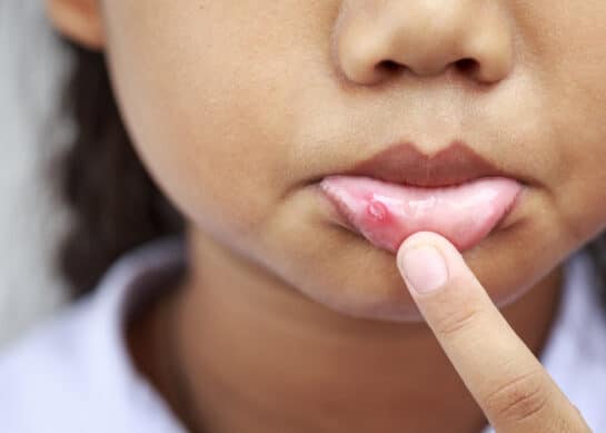 Leki na afty – preparaty i domowe sposoby